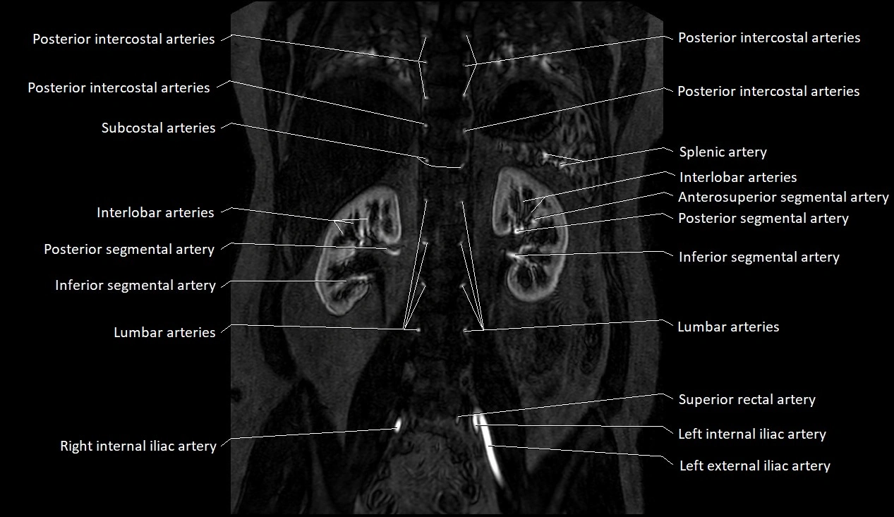 MRA Abdomen coronal anatomy image 33.webp